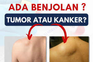 Obat Herbal Kanker Alami Terbaik